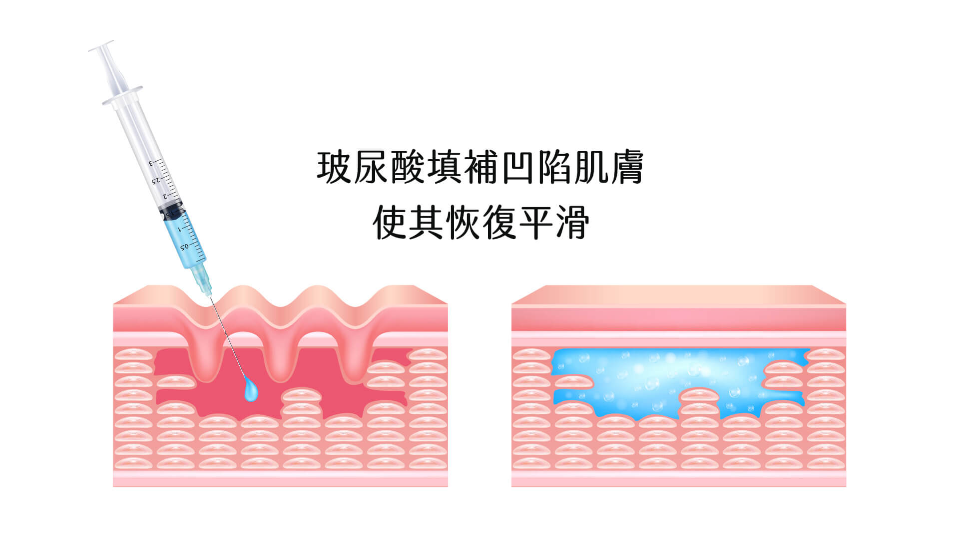 玻尿酸全臉改造雕塑 - 東京小野-台中醫美診所推薦