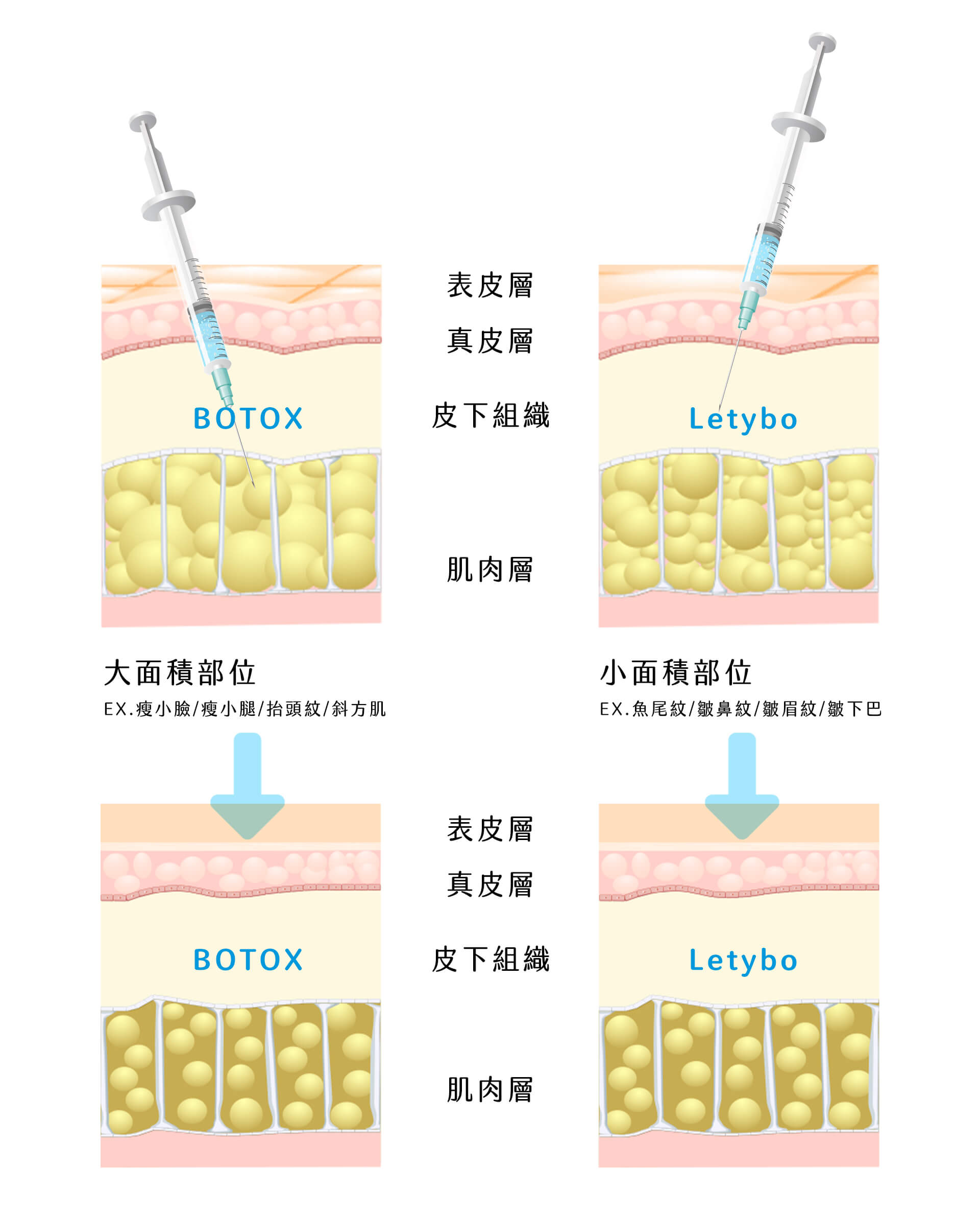 深淺式施打肉毒桿菌 - 東京小野-台中醫美診所推薦