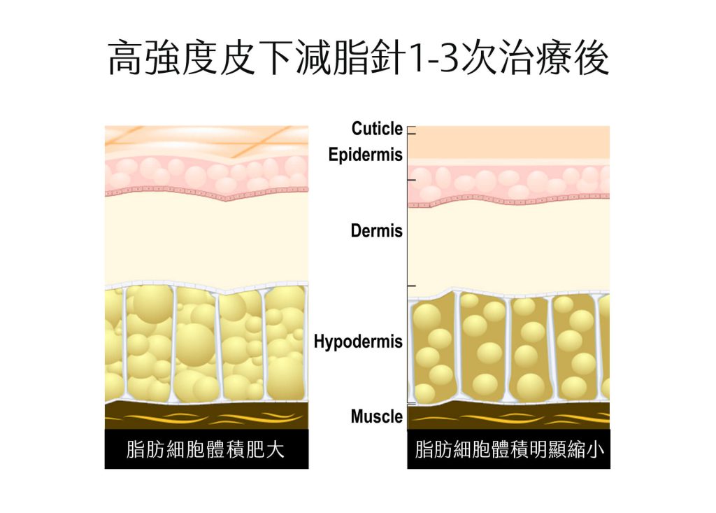 高強度皮下消脂針 - 東京小野-台中醫美診所推薦