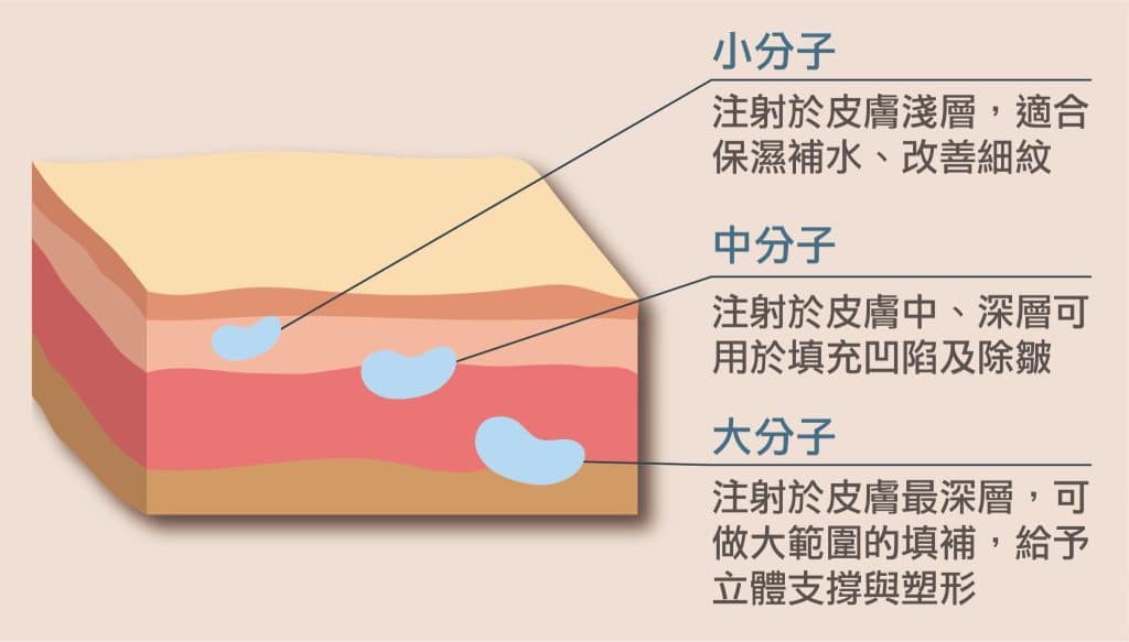 玻尿酸小分子中分子大分子-注射部位