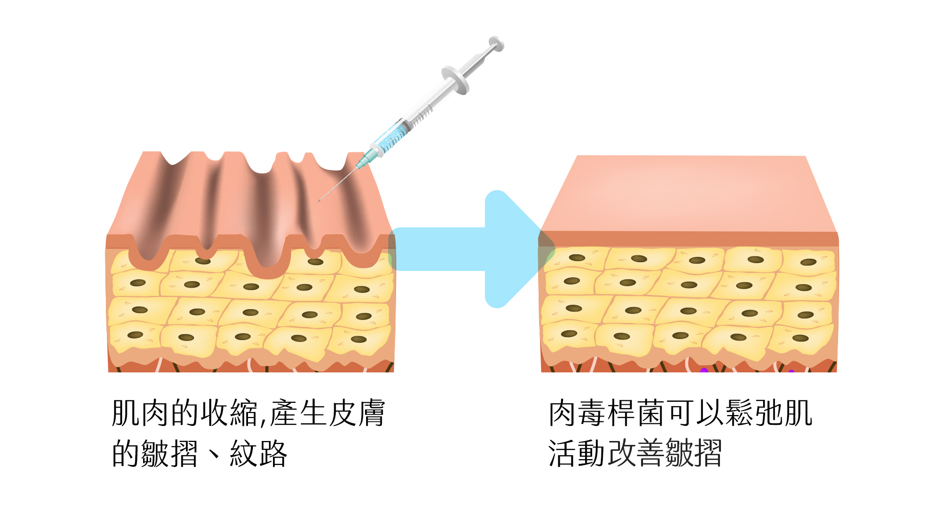 深淺式施打肉毒桿菌 - 東京小野-台中醫美診所推薦