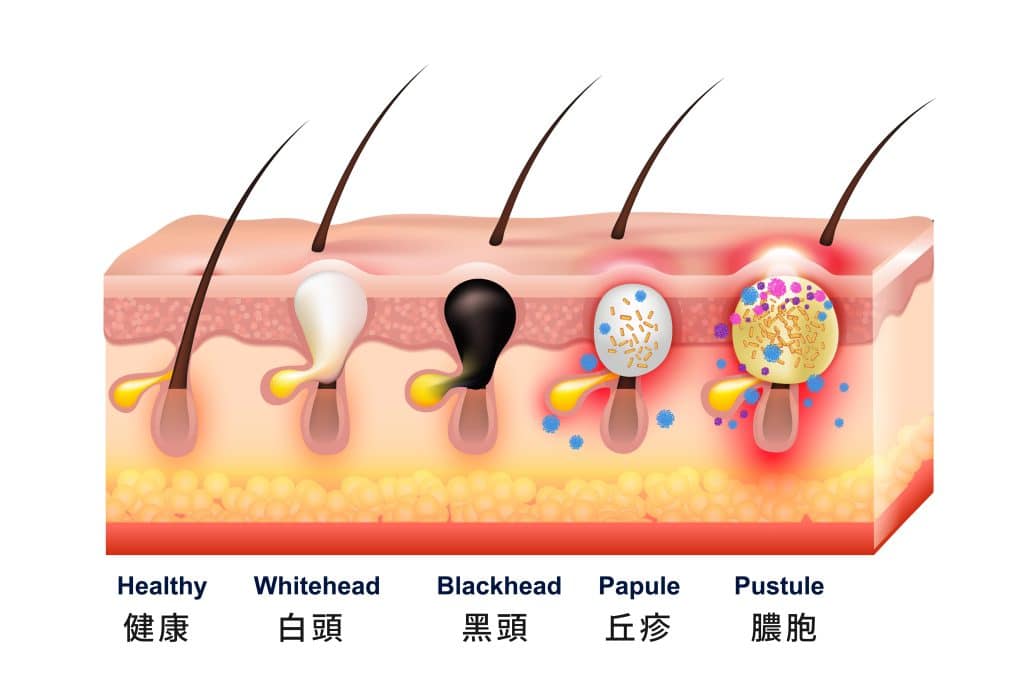 【痘痘話題專欄】油性肌膚就比較容易長痘痘嗎？要怎麼避免？７大了解油肌處理方法！5分鐘快速筆記，檢測肌膚！ - 東京小野-台中醫美診所推薦