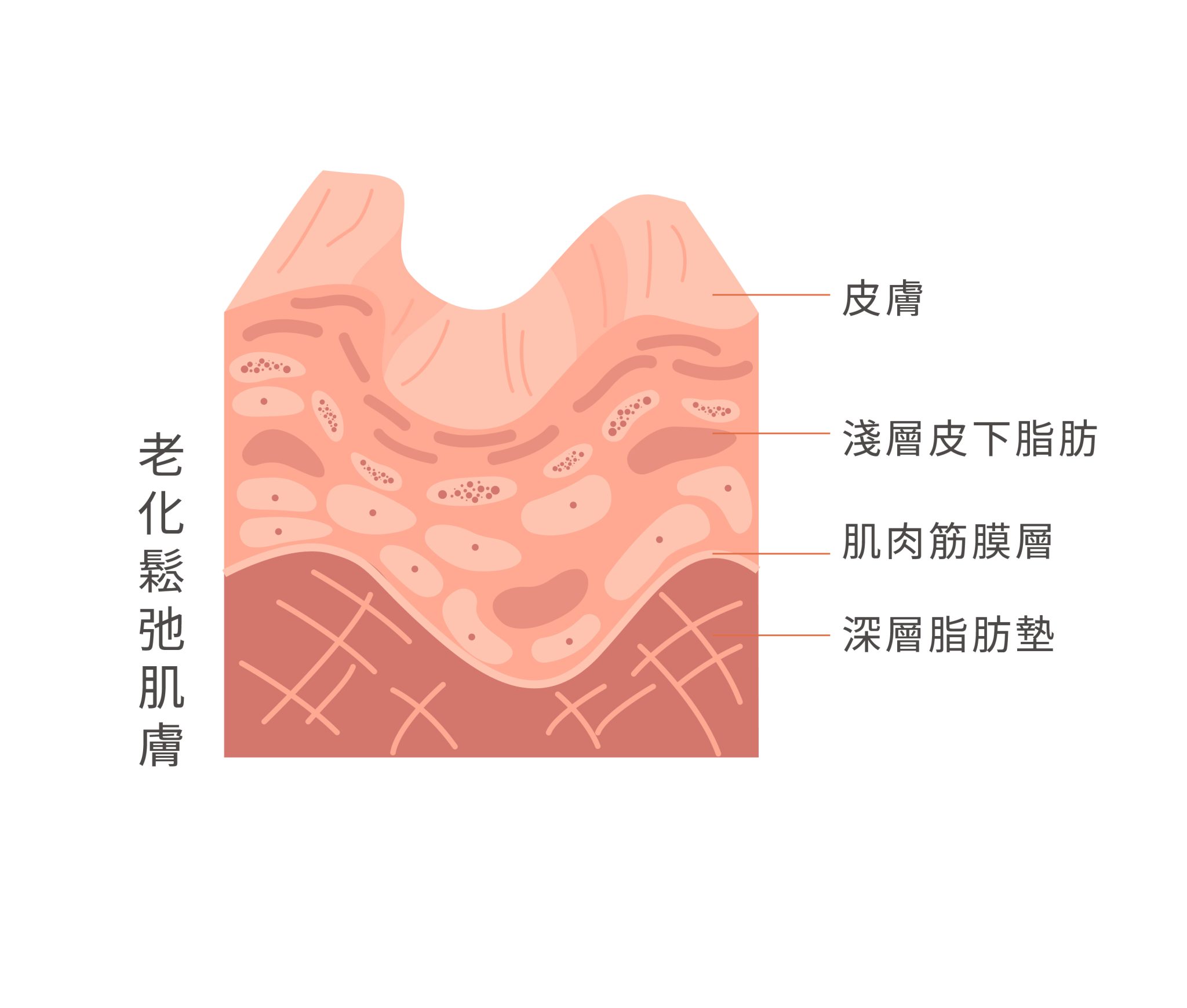 海芙音波三代 - 東京小野-台中醫美診所推薦