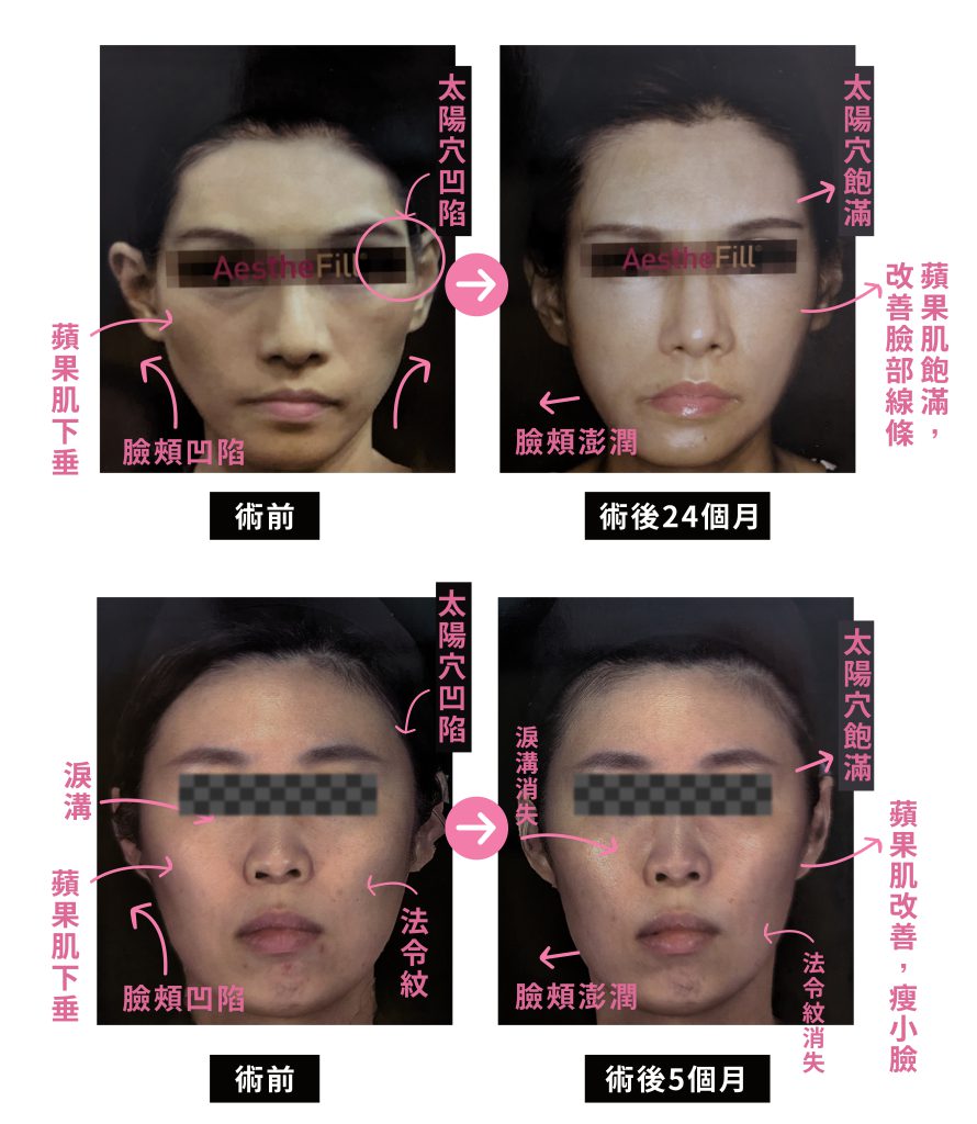 精靈針 2 工作區域 1 複本 16 工作區域 1 複本 16