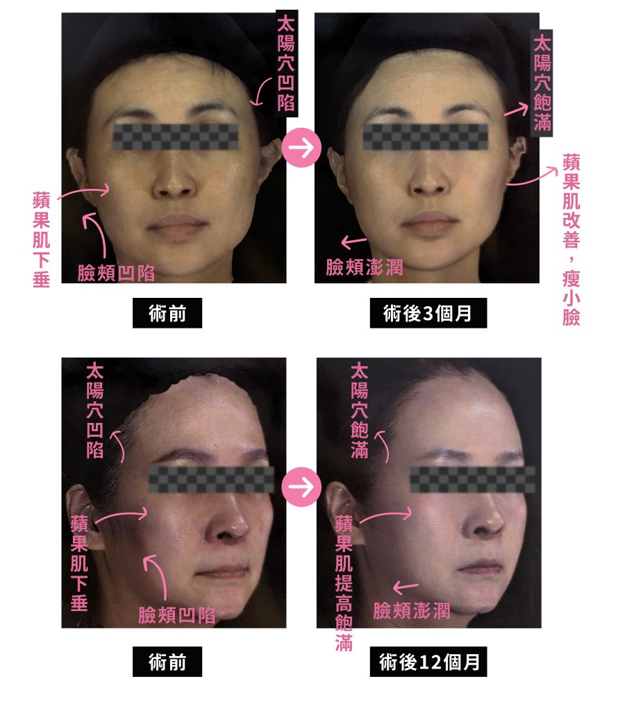 精靈針 2 工作區域 1 複本 16 工作區域 1 複本 17